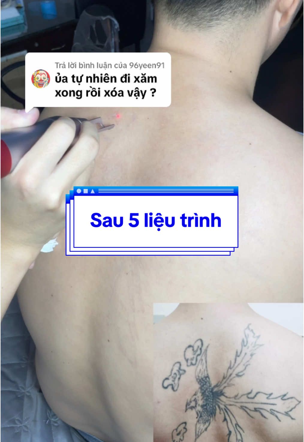Trả lời @96yeen91  hình xoá sau 5 liệu trình #XóaXăm #xoaxam3khong #xoaxamlaser #TattooRemoval #hungxoaxam 