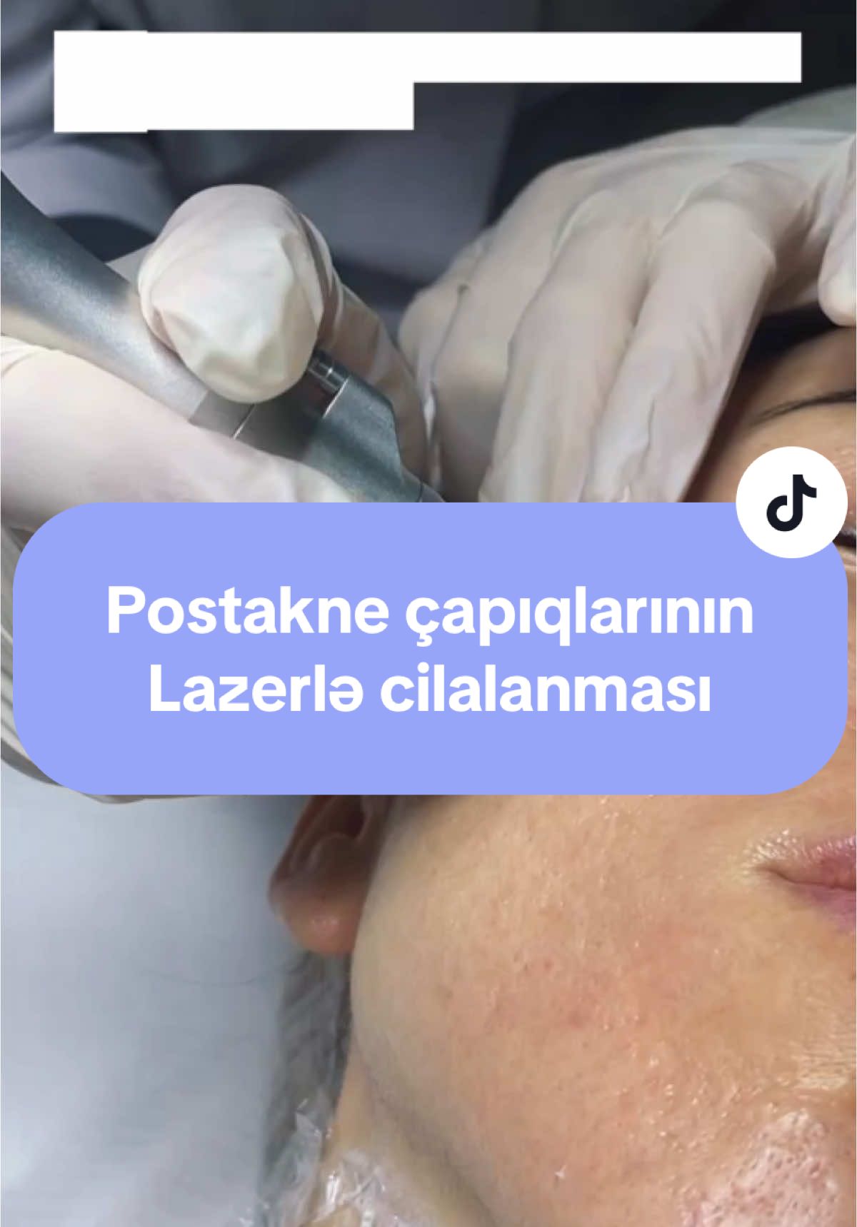 Həkim, Dermatoloq-Kosmetoloq Dr.Gülşən Əzizova #çapıq #çapıqlarınmüalicəsi #çapıqlarınlazerlemüalicəsi #çapıqlarınlazerləmüalicəsi #çapıqlar #çapıqlarınmüalicesi #çapıqlarınlazerlemüalic #çapıqmüalicəsi #capiq #capiqmualucesi #capiqmualicesi #capiqlarinmualicesi #scar #scartreatment #scartreatments #scartreament #scarlasertreatment #scarlaserremoval #Scar Laser Treatment Parut Lekuk #scar #baki #azerbaycan #baku #azerbaijan #dermatologiya #kosmetologiya #dermatoloq #kosmetoloq #шрам #шрамы #шрамыналице #шрамналице #лечениешрамов #рубцы #лечениерубцов #дерматология #дерматолог #косметология #косметолог #баку #азербайджан #врекомендации #keşfet #fyp