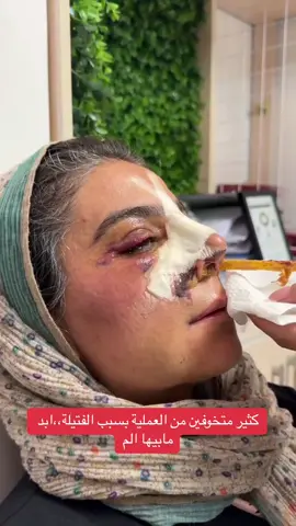 كثير متخوفين من عملية تجميل الانف بسبب الفتيلة،،ابد ما تخوف وجدا سهله #جراحي #تجميل_الانف #طب #صورت #تجميل_نساء #بيني #عمليات_تجميل #تجميل 