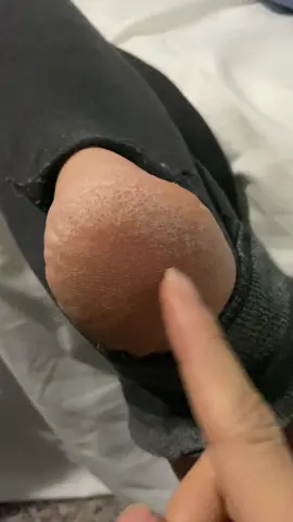 We neglected our heels since we barely wear socks but these heel socks definitely helped relieve that cracked skin for us #heelsocks #footpain #footrelief #heelpain #crackedheel 