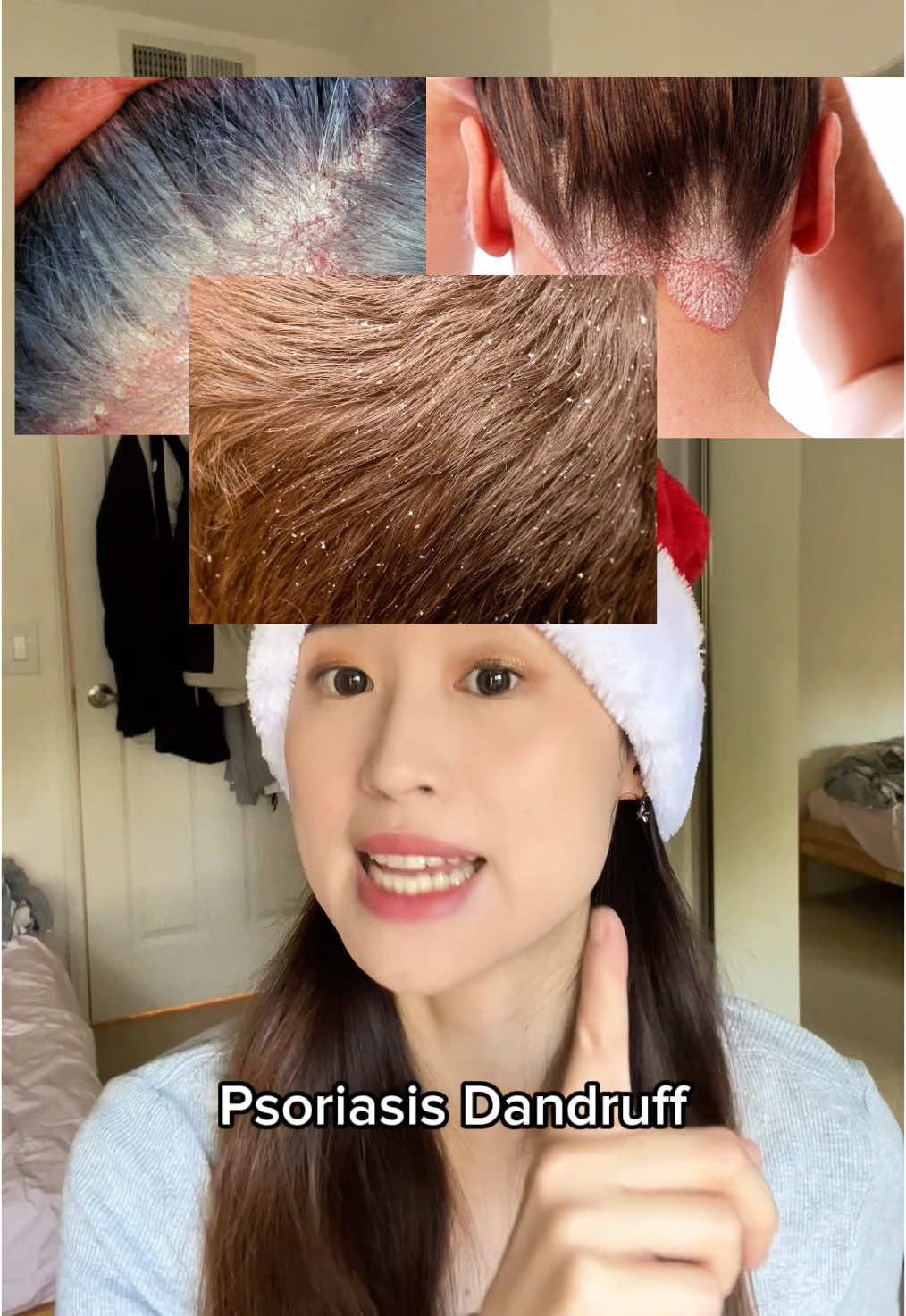 Scalp issues? TRY THIS #psoriasis #psoriasisawareness #seborrheicdermatitis #dermatitis #dryscalp #itchyscalp #dandruff #coaltar #shampoo #scalpcare 