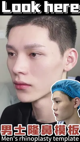 #rhinoplasty #nose #鼻综合 #鼻修复 #隆鼻 #鼻整形 #帅哥 