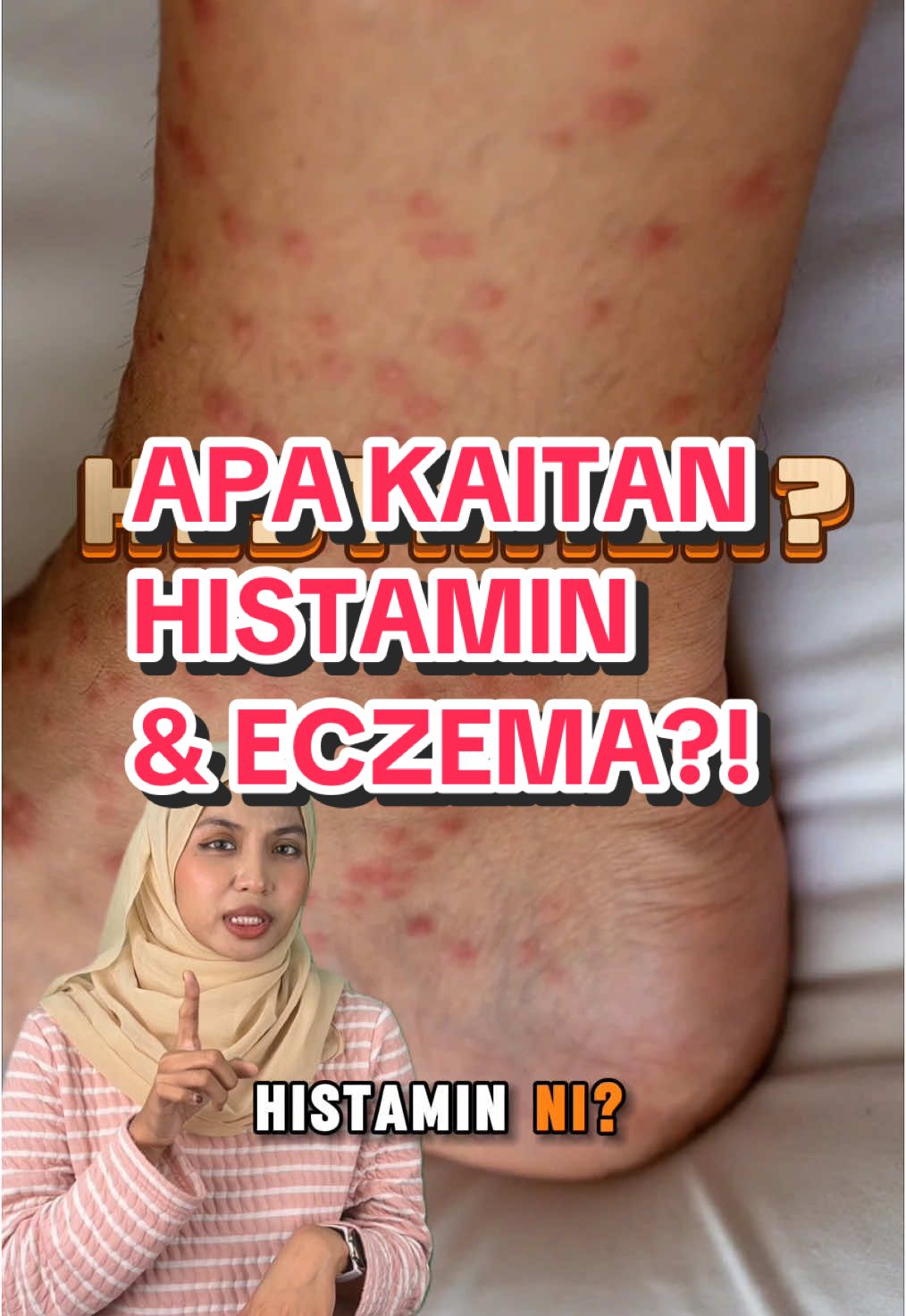 HA APA TU HISTAMIN?! APA KAITAN DENGAN ECZEMA?? #eczema #histamine #itchy #eczemaflareup #acneskin #eczemaawareness #demicure #eczemahealing 