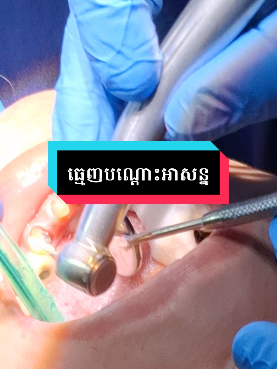 check up ធ្មេញបណ្តោះអាសន្ន 🦷 #គ្លីនិកធ្មេញគ្រេតស្មាល #greatsmiledentalclinic #greatsmiledentalcambodia #braces #teamធ្មេញដែក 