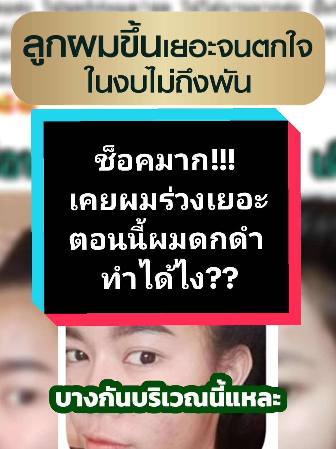 ปัญหาผมร่วง ผมบาง แก้ไขได้ด้วยฮาวิล่าห์แชมพูและแฮร์โทนิค ด้วยสถิติการรักษาได้ผลเป็นอันดับ 1 สิบปีซ้อน ผลิตภัณฑ์แนะนำ (ชุดที่เห็นผลมากที่สุด) 1. ฮาวิล่าห์แชมพู ขนาด 300 ml. ราคา 890 บ. (จากราคาปกติ 1,190 บ.) 2. ฮาวิล่าห์แฮร์โทนิค ขนาด 100 ml. ราคา 690 บ. (จากราคาปกติ 990 บ.) ผมร่วงน้อยลงชัดเจนตั้งแต่ชุดแรกที่ใช้ และผมเริ่มขึ้นใหม่ในเวลา 3-4 เดือน #แชมพูลดผมร่วง #เซรั่มปลูกผม #ลดผมร่วง #ฮาวิล่าห์  #havilah 