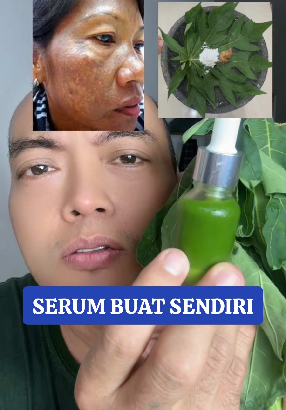 Flek hitam bandel #flekhitam #melasma 