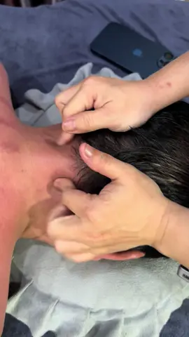 hươngsen -trị -liệu-dong-y  Massge Vùng Cổ Cải Thiện Đau Đầu ,  #chamsocsuckhoechudong #duongsinhdongy #trilieuvaigay 