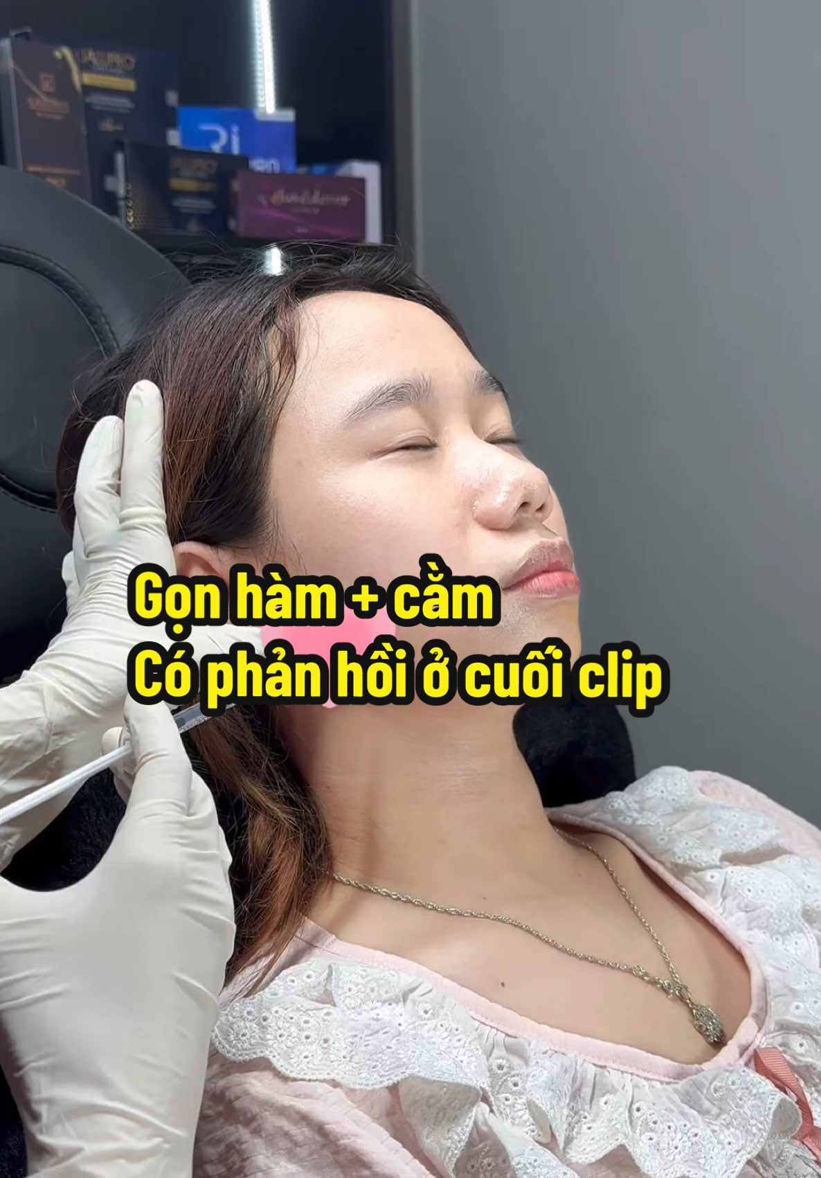 Botox gọn hàm đón tết 