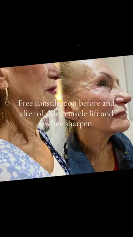 🌟 **Introducing Our 3-Step Non-Surgical Facelift!** 🌟 Are you ready to rejuvenate your appearance without the need for surgery? Our revolutionary treatment offers amazing benefits that will leave you feeling youthful and radiant! ✨ **Benefits of Our Non-Surgical Facelift:** - **Plumps Aging Skin:** Stimulates collagen, elastin, and hyaluronic acid for a firmer, fuller complexion. - **Lifts and Tones:** Targets limp, sagging muscles in the jowl, face, and neck to sharpen your jawline and restore youthful contours. - **Reduces Fatty Deposits:** Effectively removes stubborn fat from the jowl and chin areas, achieving a more defined profile. 💥 **Special Offer:** Just £199 (normally £299)! 💥  🎄 **Get yours before Christmas for a fresh new look in your pictures and videos this season!**  Don’t miss out on this incredible opportunity to transform your look. Book your appointment today and embrace a more youthful you! 💖 📞 Call us now or send us a message to secure your spot!   07468694308  Both clinics are available by appointment choose from  Ballyclare or Holywood in Belfast 😘  #NonSurgicalFacelift #YouthfulGlow #Beauty #SelfCare #HolidayReady