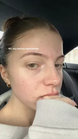 @The Ordinary never fails us 🫶🏻 #theordinary #theordinaryskincare #theordinaryniacinamide #skincare #niacinamide #serum #niacinamideserum #bestskincare #clearskin #glowyskin #affordableskincare #fyp #4u #girlssupportgirls 