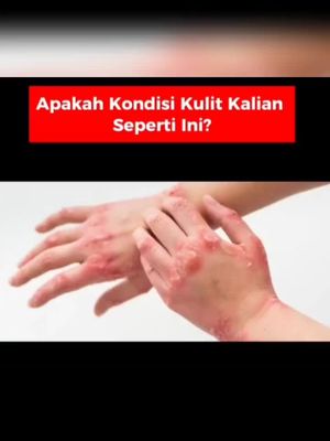 GATAL GATAL BISA SEMBUH. Gunakan Salep Youzhi atasi segala masalah pada kulit. sudah BPOM