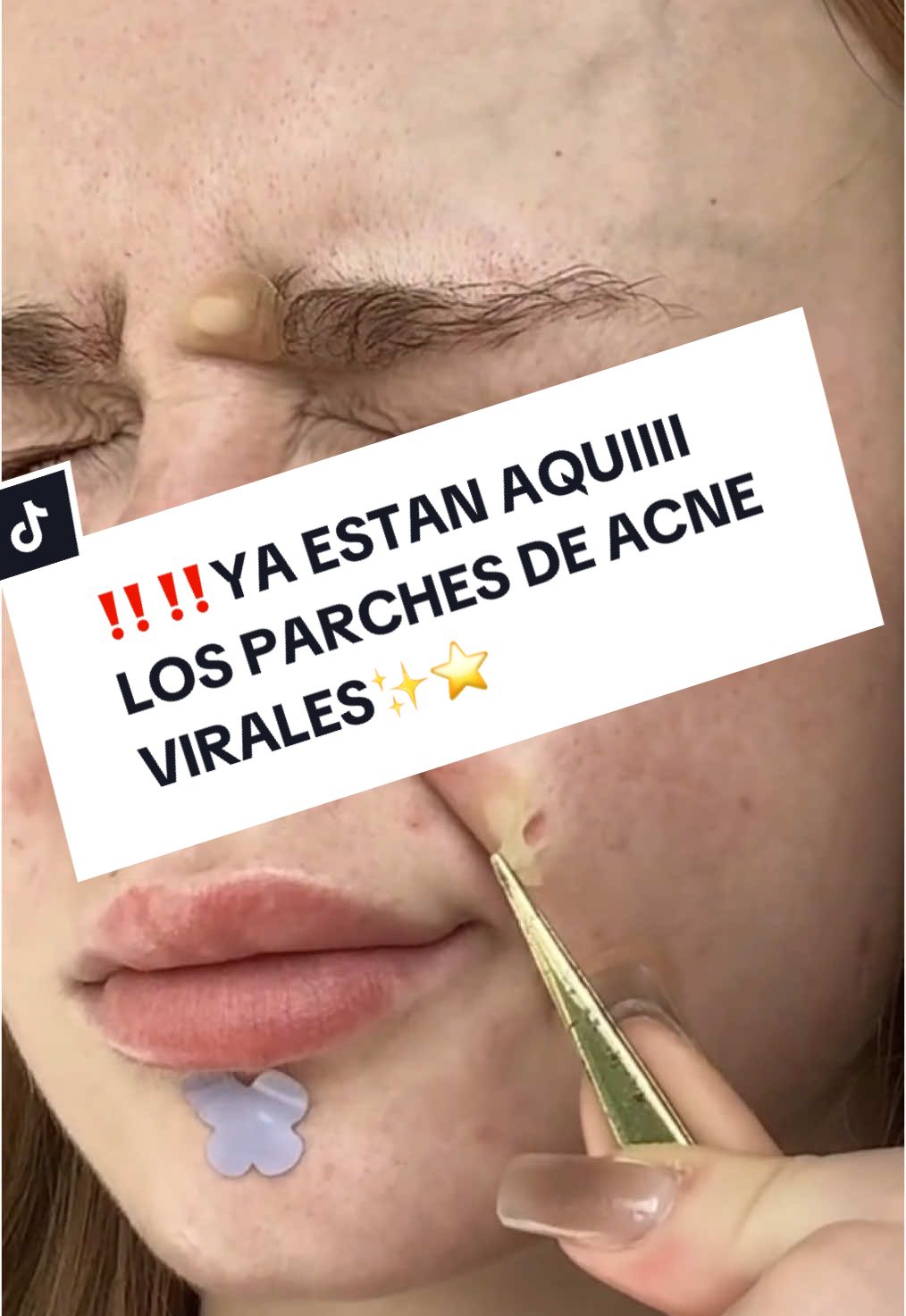 #parches  #parchesacne #parchesacneyuya #parchesacné #acne #cuidadodelapiel #skincare #skincareroutine #skincaretips #skincareviral #skincareproducts #skintok 