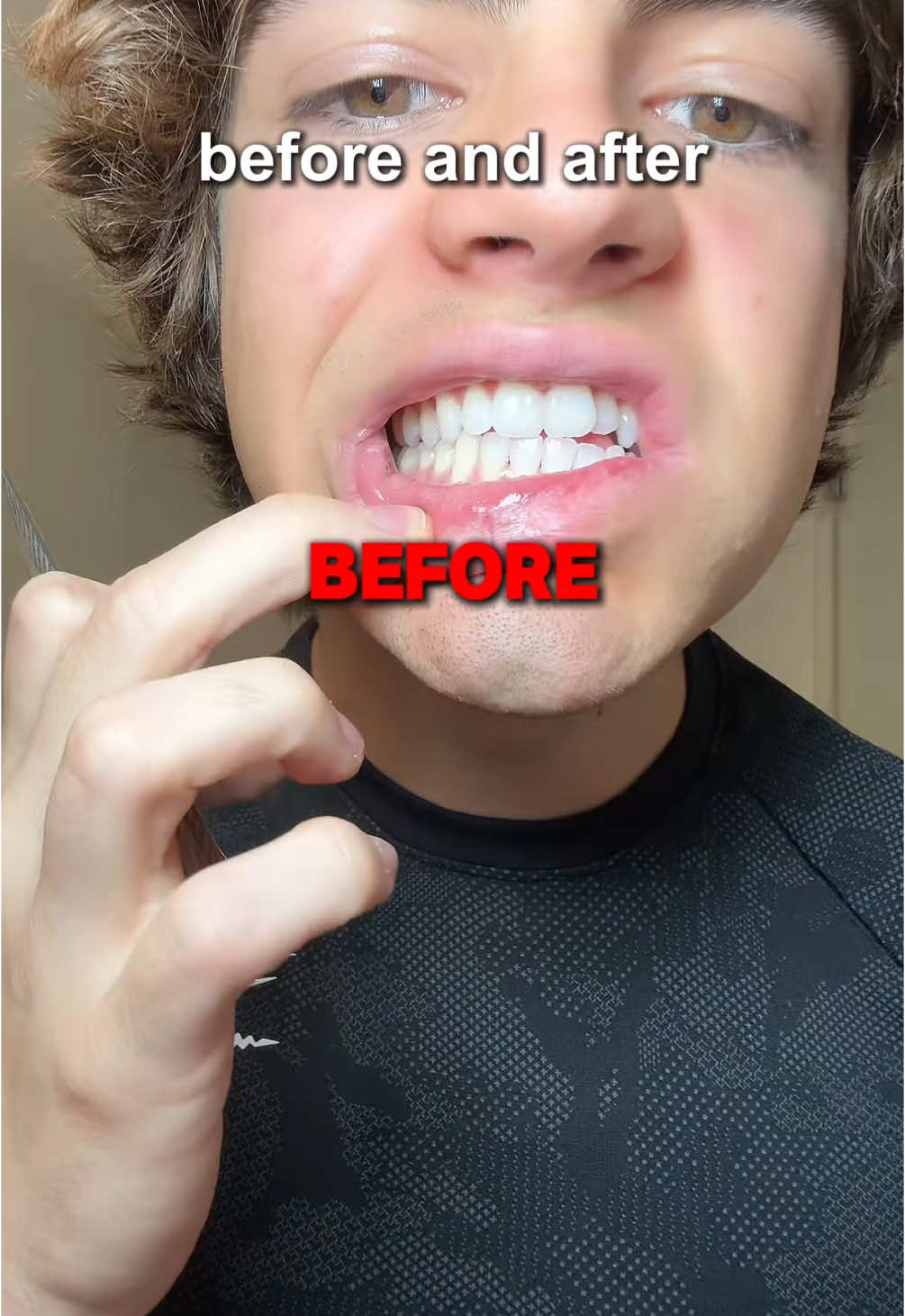 Teeth whitening strips before and after 😱 #dillonlatham #whiteningstrips #teethwhitening