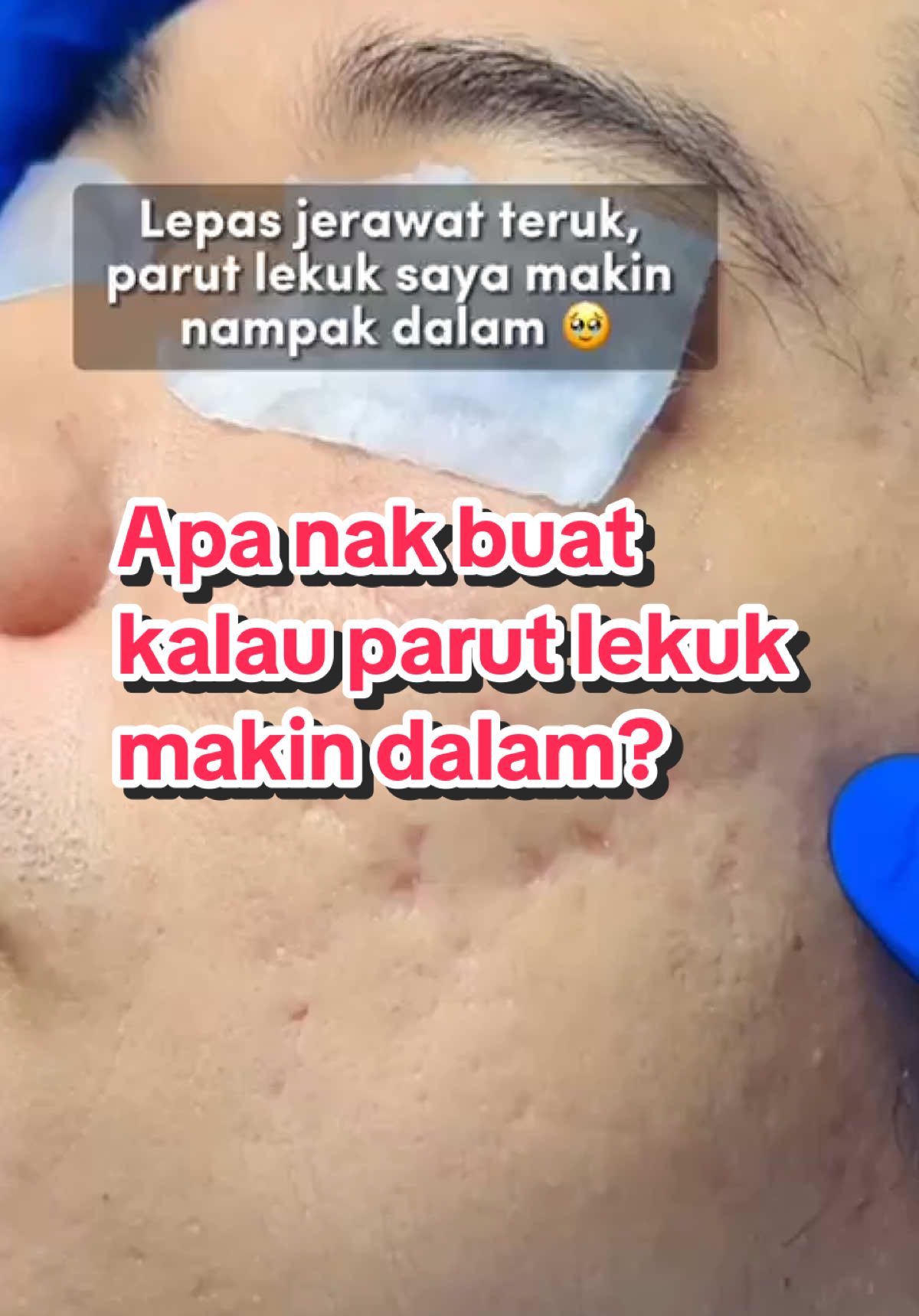 Apa nak buat kalau parut lekuk makin dalam? 🥹 #subcision #subcisiontreatment #rawatanparut #parutlekuk #scartreatment #scar #klinikkulit #klinikdrbazilah #fyp 