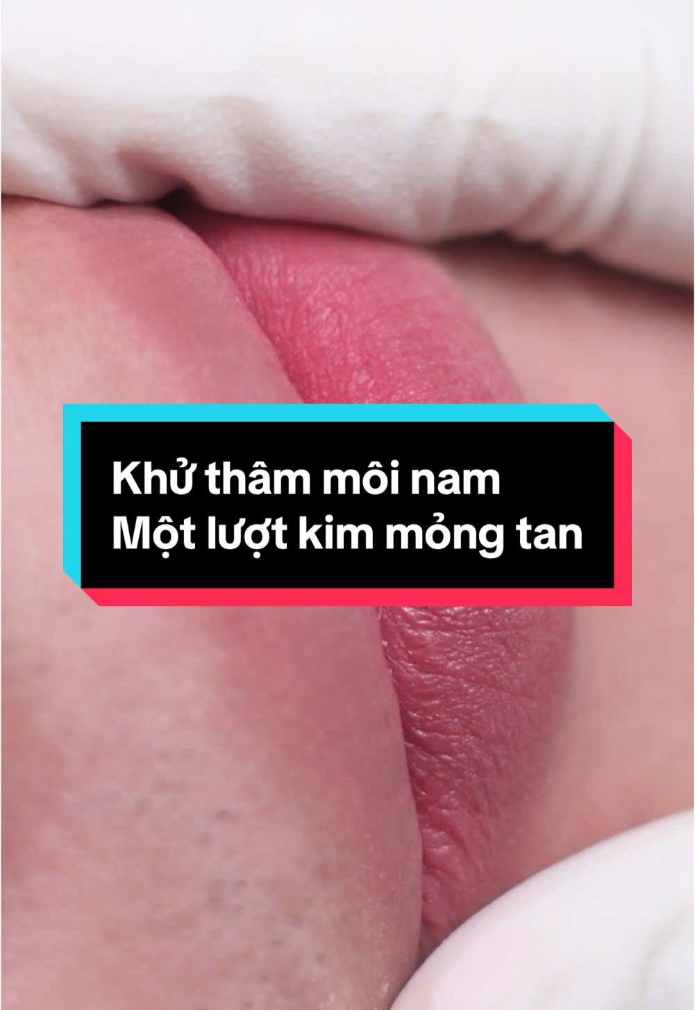 Cân bằng sắc tố thâm cho môi Nam , đối với đôi môi này của khách hàng có những sắc tố thâm và nám trên môi. Sau 1 lượt cân bằng lại bằng kỹ thuật softlips đã khiến môi hồng hào nhẹ nhàng tự nhiên hơn. Còn chờ gì nếu môi mình còn thâm mà chưa đến Mai Tuyet Ha Academy khử thâm ngay nào 😉