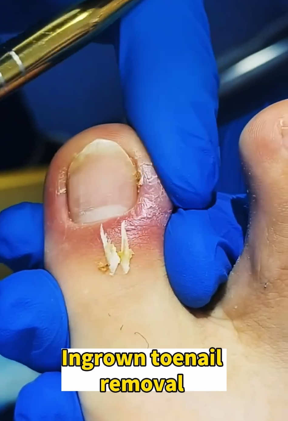 #toenailremoval #tiktokchallenge #foryou #viralvideo #thisis4u #ingrowntoenail #nails #toenails #pedicure