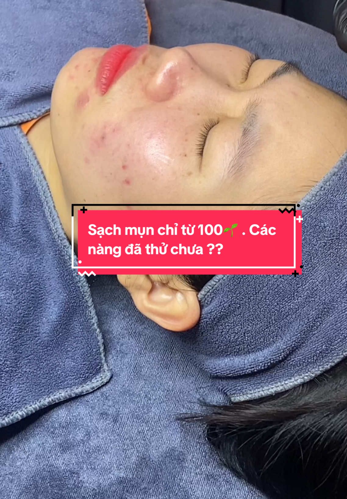 Sạch mụn chỉ từ 1..🌱 các nàng thử chưa? . Hoàn toàn bằng dmp , an toàn hiệu quả . Các nàng cbi diện mạo mới đón tết chưa ạ . In bốc tui nha #lamdep #bacninh #duocmypham #dmp #peelda #daotaohocvien #daotaohocvienchuyennghiep #laymun #laymunchuanykhoa 