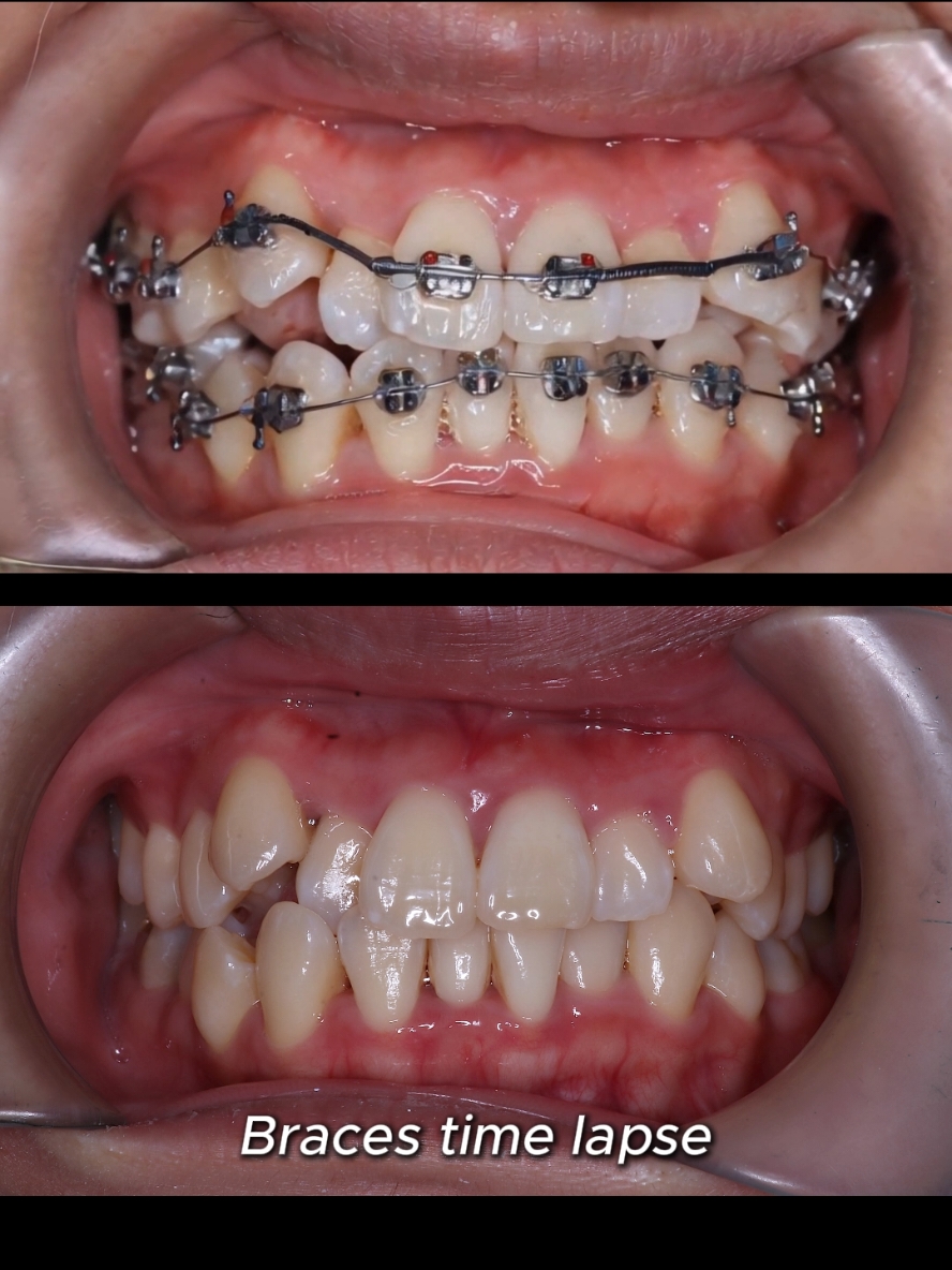 Braces time lapse, fix crooked teeth. 25 months duration #braces #brackets #orthodontist #dentist #dentistry #dental #bracesoff 