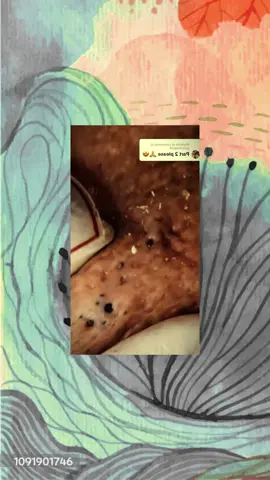 #squeezeyuk #satysfying #pimple #foryou #relax