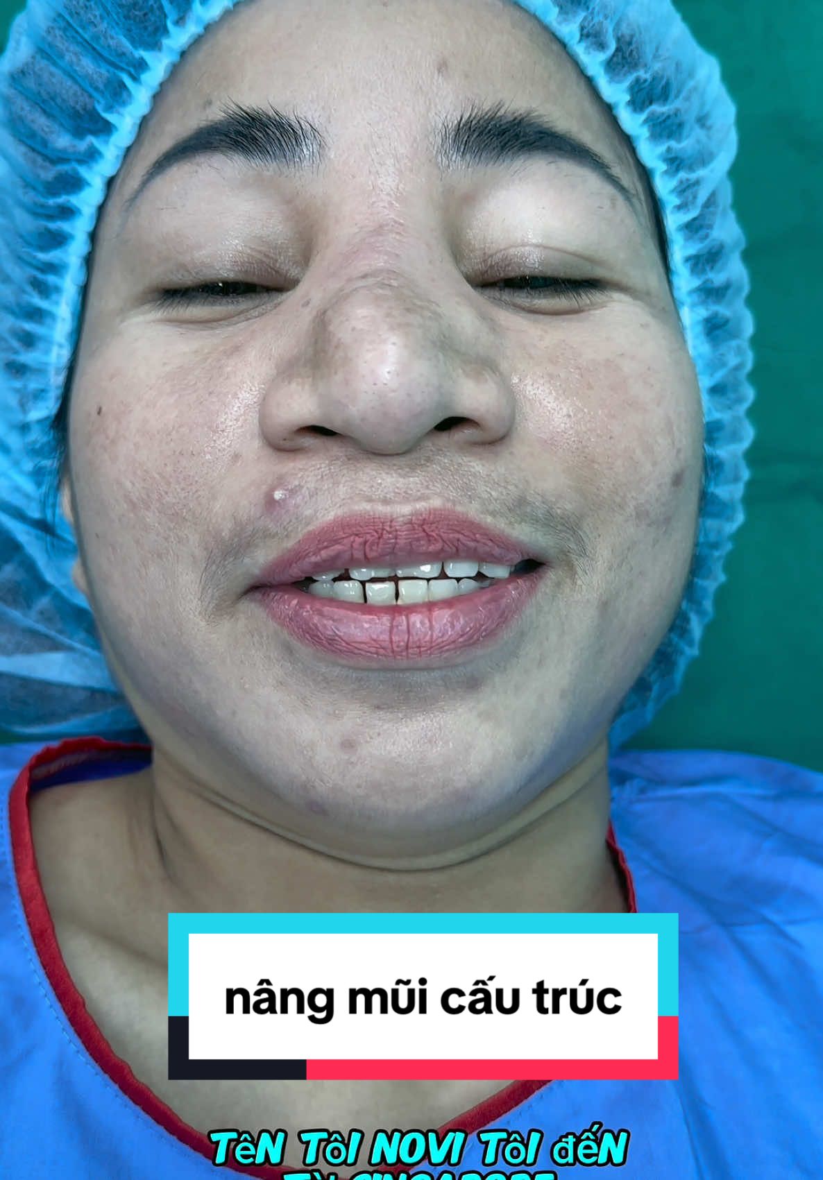 sự thay đổi cho em gái indonesia trước và sau khi nâng mũi ntn #xuhuong #drhuynh #hidung #nose #suamuihong #nangmuicautruc #pttm #taiwan #indonesia 