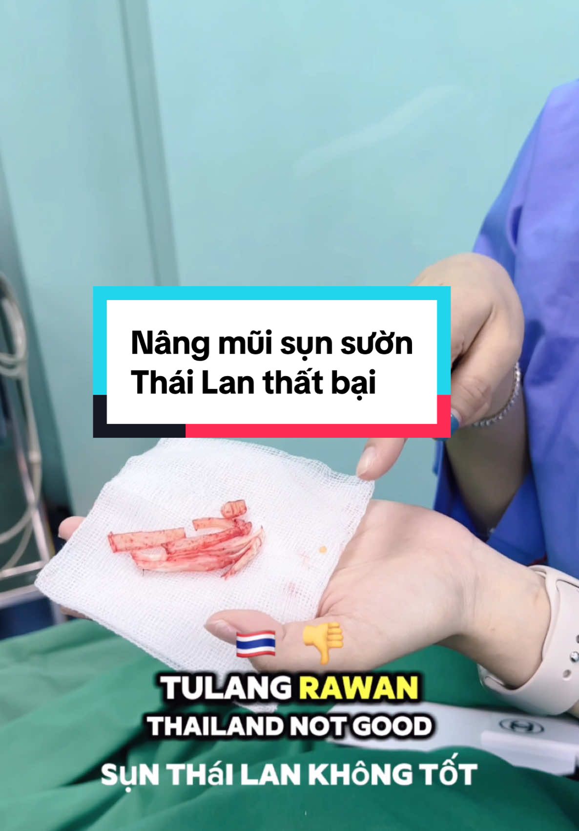 Operasi hidung tulang rawan rusuk Thailand yang dilakukan pelanggan Indonesia gagal ... #operasihidung #hidung #rhinoplasty #nose #bsiviet 