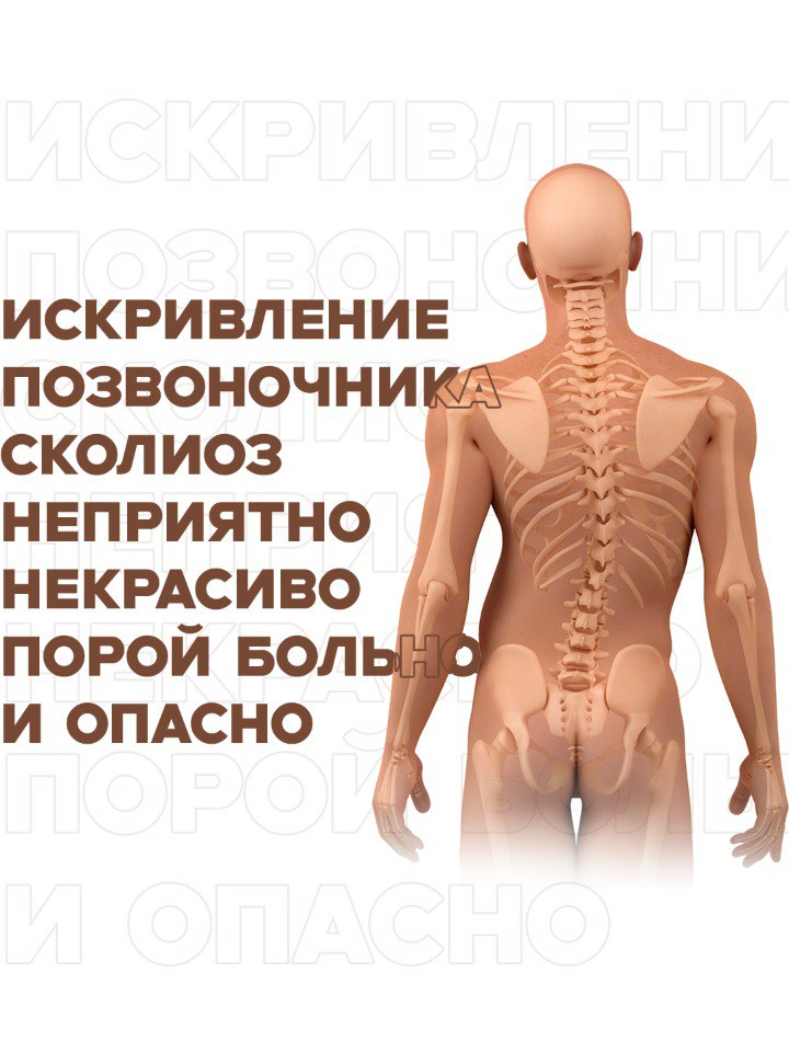 ИСКРИВЛЕНИЕ ПОЗВОНОЧНИКА, СКОЛИОЗ, НЕПРИЯТНО, НЕКРАСИВО, А ПОРОЙ БОЛЬНО И ОПАСНО. Известно, что в норме позвоночный столб прямой. Его постепенное искривление происходит под воздействием ряда причин:  Врожденные заболевания позвоночного столба;  Вторичные причины — после операций на грудной клетке, позвоночнике, в результате переломов, укорочения одной конечности и так далее;  Нервно-мышечные патологические процессы, сопровождающиеся слабостью мышц, нарушением нервной проводимости;  Беспричинный, или идиопатический сколиоз — встречается в 80% случаев диагностики стойкой деформации позвоночника.  Развитие сколиоза сопровождается его искривлением во всех плоскостях, а также приводит к скручиванию. Заболевание серьезное, развивается медленно – в течение многих месяцев и лет. Если не выявить проблему на ранних стадиях, то могут наступить необратимые изменения, которые устраняются только хирургическим путем.  Как распознать сколиоз?  Наличие деформации позвоночника определяется по следующим признакам:  Линия позвоночного столба искривлена;  Есть разница в уровне по линии плеч, талии и бедер;  Одна лопатка может выпирать или быть ниже другой;  Голова слегка наклонена в одну сторону;  Молочные железы могут быть несимметричны;  В тяжелых случаях — сильное выпирание ребер с одной стороны (реберный горб), и их западение с другой.  Сколиоз может сопровождаться появлением болей в спине, грудной клетке. В запущенных случаях происходит сдавливание позвоночником и грудной клеткой внутренних органов — легких, сердца, а также спинномозговых нервов. Больной жалуется на одышку, он часто болеет ОРВИ и пневмонией. Его повседневная физическая активность ограничена, могут беспокоить боли в области сердца, в животе, головные боли.  Начальные стадии сколиоза успешно подвергаются коррекции!  Хирургическое лечение назначается в запущенных случаях, когда угол деформации позвоночника превышает 40−50 градусов, и надо срочно остановить его дальнейшее искривление.  При появлении первых признаков сколиоза необходимо немедленно начать коррекцию, что поможет избавиться от данной проблемы без операции.   Переходите по ссылке doctoreni.taplink.ws/  в шапке моего профиля @doctor.eni  🔺Тема: ИСКРИВЛЕНИЕ ПОЗВОНОЧНИКА ( СКОЛИОЗ )   И начинайте устранять эту проблему уже сейчас!