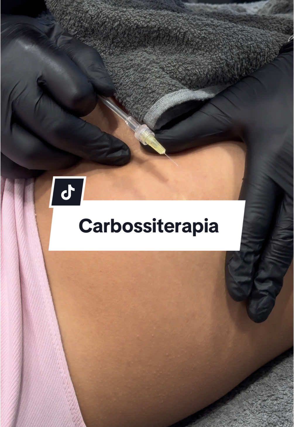 La carbossiterapia è un trattamento estetico non invasivo che utilizza l’anidride carbonica (CO₂) per migliorare la circolazione e stimolare il metabolismo cellulare. Consiste nell’iniezione sottocutanea di CO₂ medicale tramite un ago sottile.  Questa procedura favorisce: 	•	Microcircolazione migliorata: aumenta l’apporto di ossigeno ai tessuti. 	•	Produzione di collagene: stimola il rinnovamento cutaneo, migliorando tonicità e elasticità. 	•	Riduzione degli inestetismi: aiuta a combattere cellulite, smagliature, rughe e occhiaie. 	•	Effetto drenante: riduce la ritenzione idrica. È generalmente rapido e sicuro, con effetti collaterali minimi come un lieve gonfiore o arrossamento temporaneo. Info e prenotazioni link in bio o su App Skinboost 🫶🏼  #medicalartmilano  @Elisa Visari 