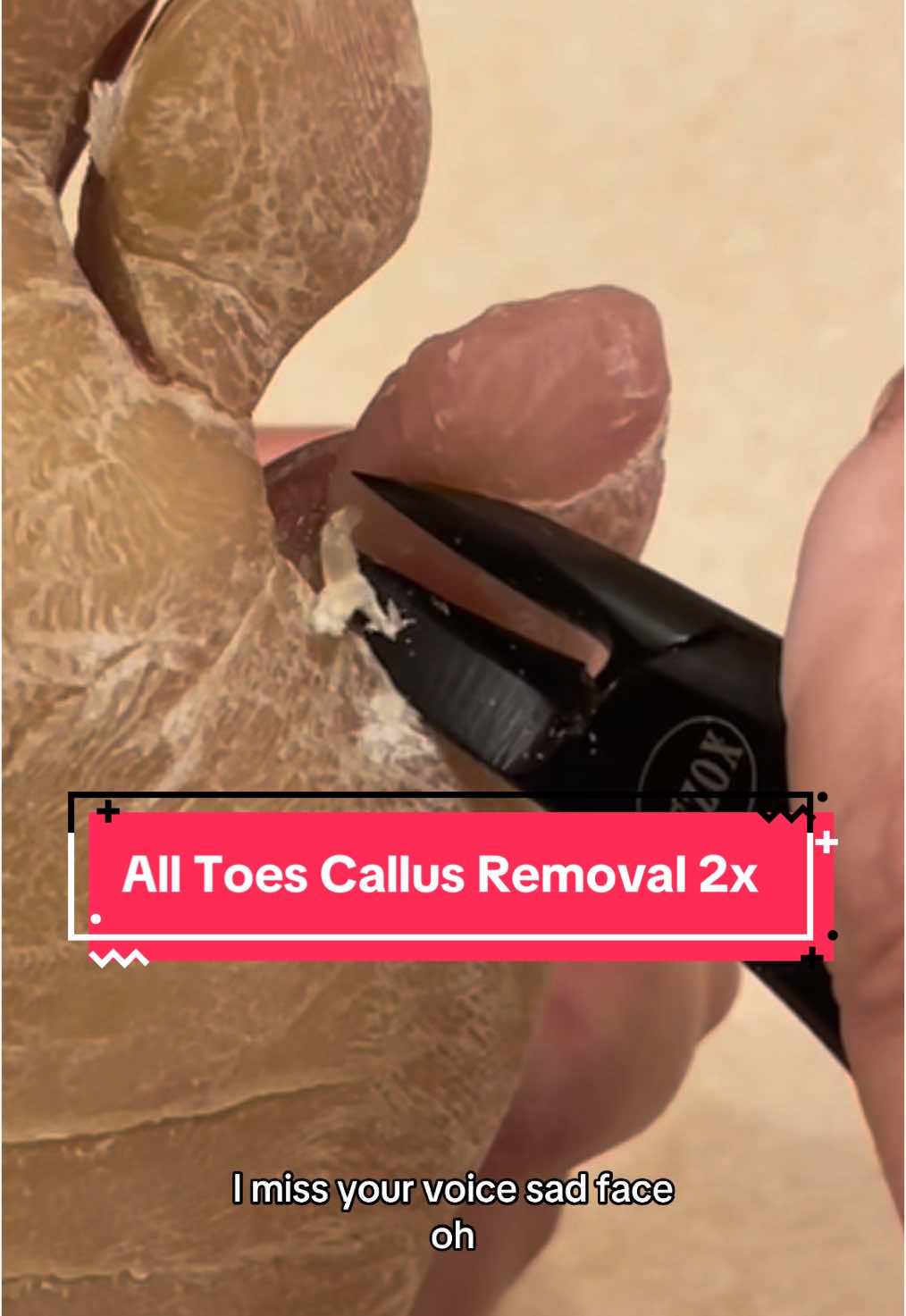 Missed you! 🥰 #parmeseanpalms #callusremoval #skinpicking #skinpeeling #podiatrist 