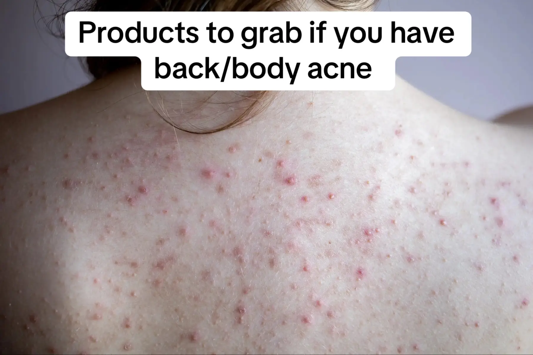 Ingredients to look for when treating body acne!  ✅Salicylic Acid  ✅Benzoyl peroxide 4-10% ✅Hypochlorus Acid  ✅Retinol (Adapalene specifically) Look for washes/Sprays as its easier to apply! #skincare #bodyacne #acnetreatment #dermatologist #skincareroutine 