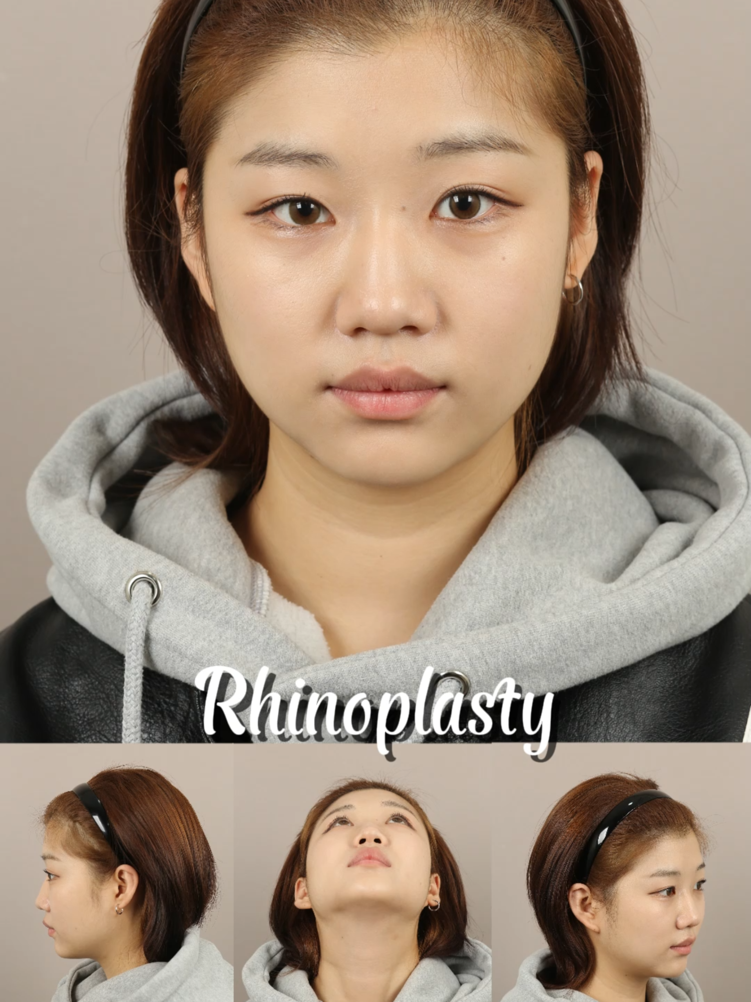 Swelling can take up to a year for#rhinoplasty  📨 For further inquiries or to book an appointment, please message us: 📧 Instagram: @lienjang_english 📧 WhatsApp: +82-10-5409-3625 #lienjang #nosejob #nosejobrecovery #beforeandafter #kbeauty