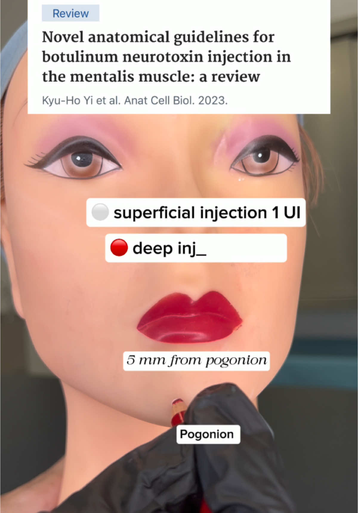 SEO trattamento del mento con botulino secondo il più recente consensus medico estetico  #reels #aestheticmedicine #fyp #botox 