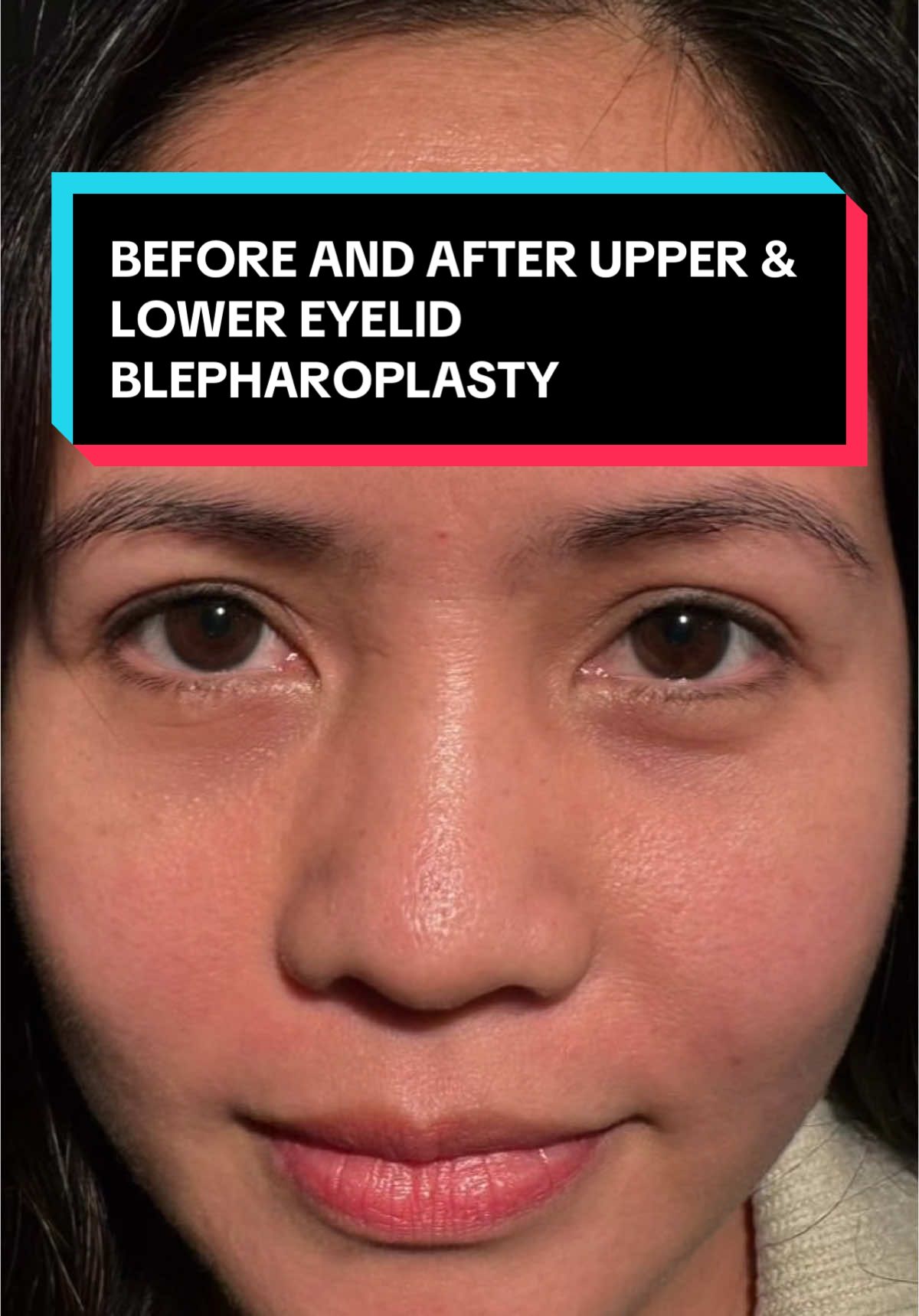 Before & after asian double eyelid, upper blepharoplasty & bilateral lower eyelid scarless blepharoplasty! #tiktok #before #after #blepharoplasty #beforeandafter #asian #eyelid #plasticsurgery #scarless #beforeandafter #fyp #results #transformation #foryou #ophthalmology #eyes #ophthalmologist 