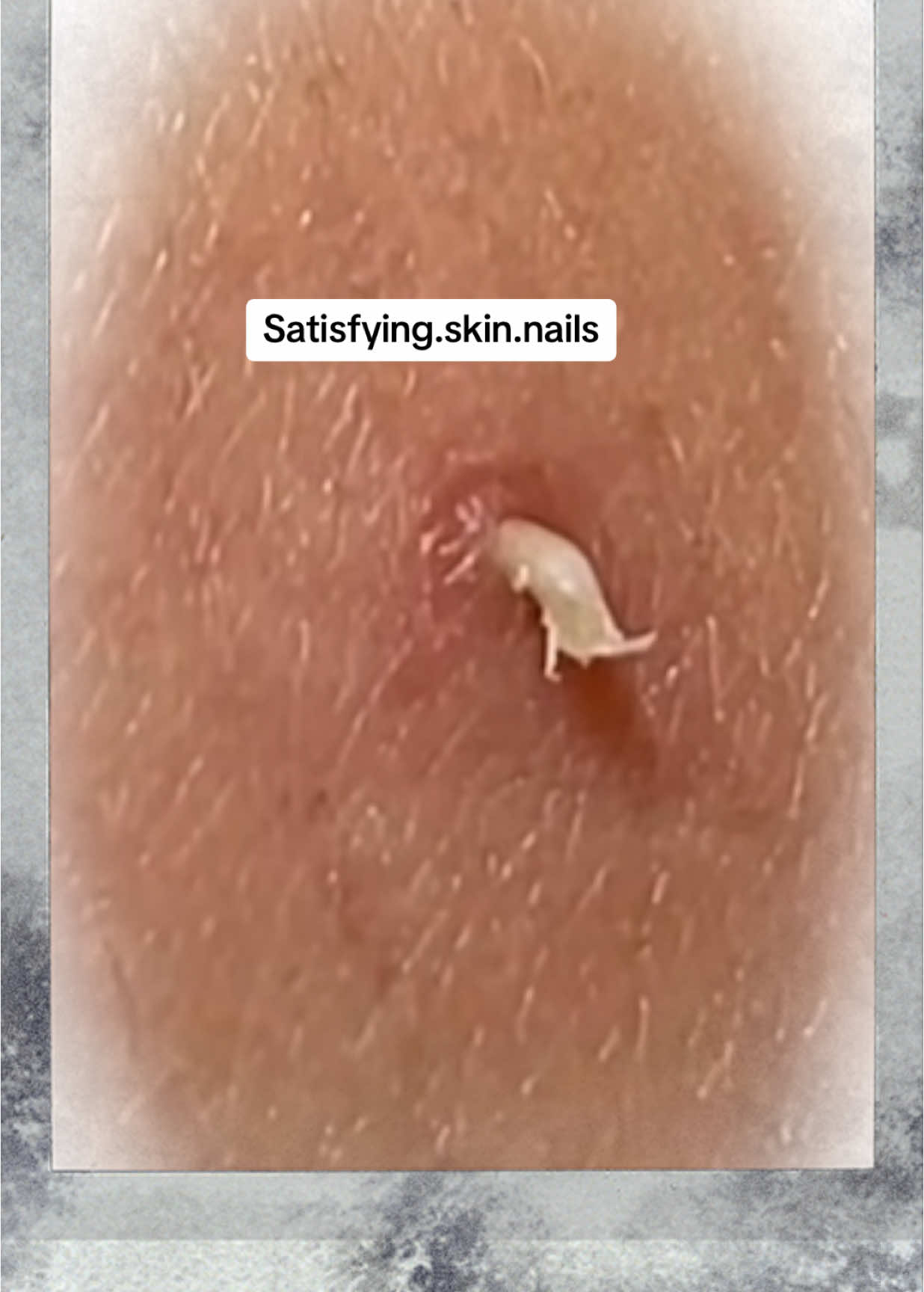 Thats a perfect catch, so precise 👌🏼🪱!! #skintok #satisfyingvideo #oddlysatisfying #satisfaction #pimples #blackheads #blackhead #pimple #pimplepatch #pimplepopperaddict #ingrown #extraction #asmr #extractions #blackheadsremoval #cyst #anxietyrelief #skintreatment #skincare 