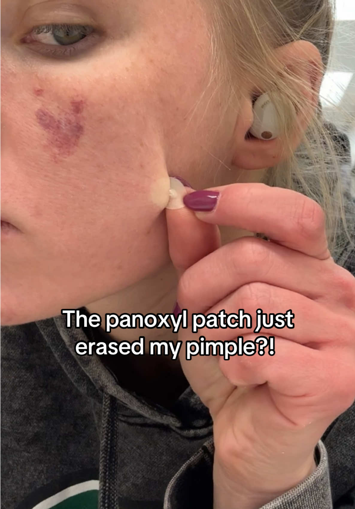 I used to be a die hard hero patch gal but panoxyl makes those ones look like childs play #pimplepatch #pimplepatchpeel 