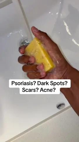 If your Dealing With Psoriasis, Ache, Dark Spots ot Scar marks that Wont Fade? You Definitely Gotta Try Out This Tumeric Soap Bundle Pack! #acne #psoriasis #darkspots #acneskin #acneproneskin #psoriasistok #acneskincare #acnetips #tumeric #tumericsoap #koji #kojicacidsoap #fy #foryourpage #tiktokshopholidayhaul 