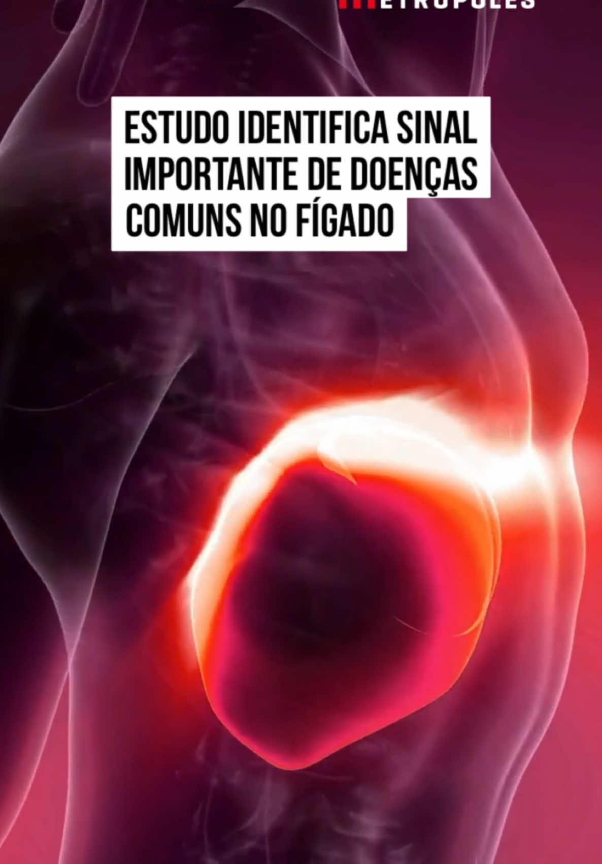 Um #estudo feito na Universidade de Basileia, na #Suíça, mostra que pacientes diagnosticados com problemas de saúde ligados ao acúmulo de gordura no #fígado têm pior qualidade do sono. Essas pessoas acordam mais vezes durante a noite e permanecem acordadas por mais tempo depois de irem para a cama. A pesquisa focou em pacientes diagnosticados com esteatose hepática associada à disfunção metabólica (MASLD), ou com a forma mais grave de esteato-hepatite associada a disfunção metabólica (MASH), ou com MASH e cirrose. As doenças estão se tornando cada vez mais comuns, impulsionadas pelo aumento da obesidade e estilos de vida sedentários. Estima-se que 30% da população da América do Sul tenha essas condições. A MASLD e a MASH são caracterizadas pelo acúmulo de gordura no fígado, que pode resultar em inflamação e danos às células hepáticas. Pessoas com MASLD correm um risco maior de diabetes, carcinoma hepatocelular (o tipo mais comum de câncer de fígado), cânceres não hepáticos, doença renal crônica, perda muscular relacionada à idade e doença cardiovascular. No artigo científico publicado na revista Frontiers in Network Physiology nessa terça-feira (3/12), os pesquisadores explicam que os sintomas de MASLD e MASH são silenciosos na fase inicial. Por isso, é importante ficar atento aos sinais. #TikTokNotícias 
