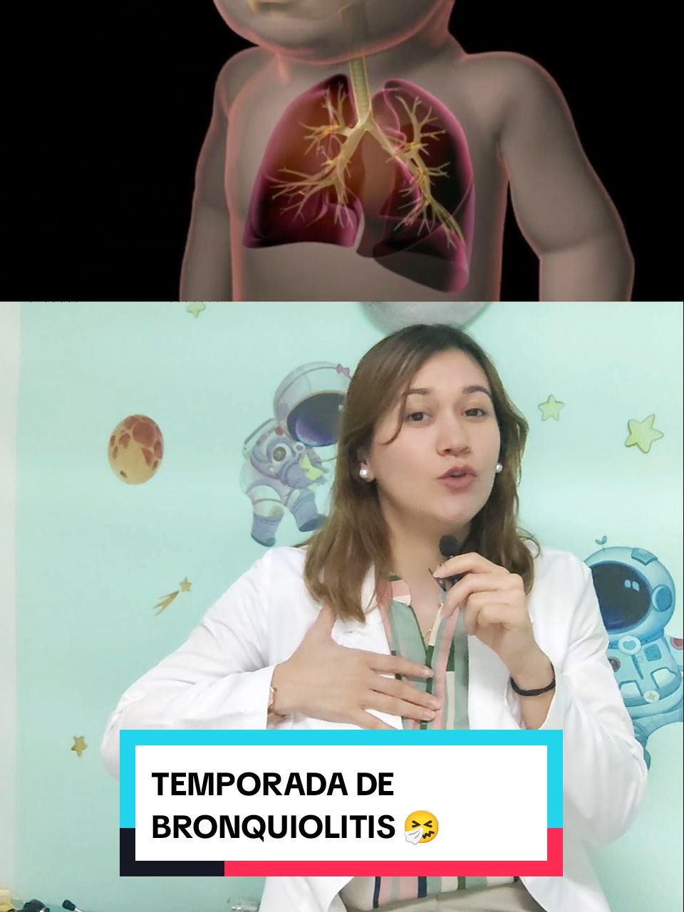 La Bronquiolitis es la inflamación de vías respiratorias bajas causando un característico sonido conocido como sibilancias, acompañado de un cuadro gripal. Los bebés son muy susceptibles a contagiarse por gotitas de saliva o contacto directo, provocando en ocasiones signos de dificultad respiratoria. ¡MUCHO OJO!  Ante cualquier síntoma o signo es mejor valorar a tu bebé.  #pediatria #culiacan #invierno #frio #virus #sincitialrespiratorio #neumonia #salud #medicina 