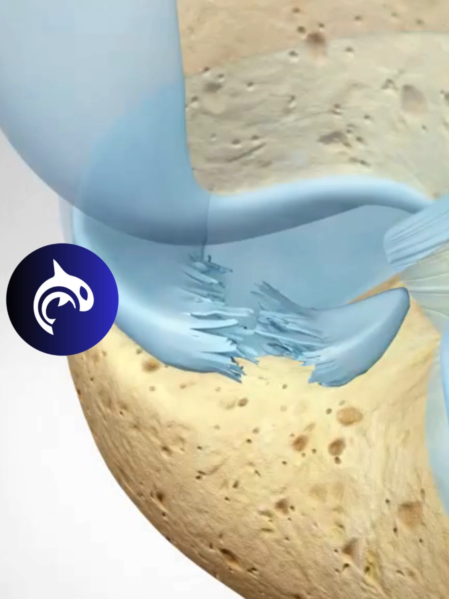 See a Meniscus Root Tear and Repair | Animated Knee Surgery A meniscus root tear can cause debilitating knee pain, swelling, and instability, impacting everyday movement and athletic performance. In this engaging animated video, we take you inside the knee to visually demonstrate the mechanics of a meniscus root tear and the innovative surgical techniques used to repair it. Watch the journey unfold as the torn meniscus is carefully reattached, restoring stability and functionality to the knee. Whether caused by trauma, sports injuries, or degeneration, a meniscus root tear is a condition that requires precise treatment, and this animation highlights the remarkable steps involved in the recovery process. 🔔 Subscribe for more visually captivating animations on knee injuries, cutting-edge procedures, and recovery tips. #MeniscusRootTear #KneeInjury #KneeSurgery  #SportsMedicine #KneeHealth #stem #medtok