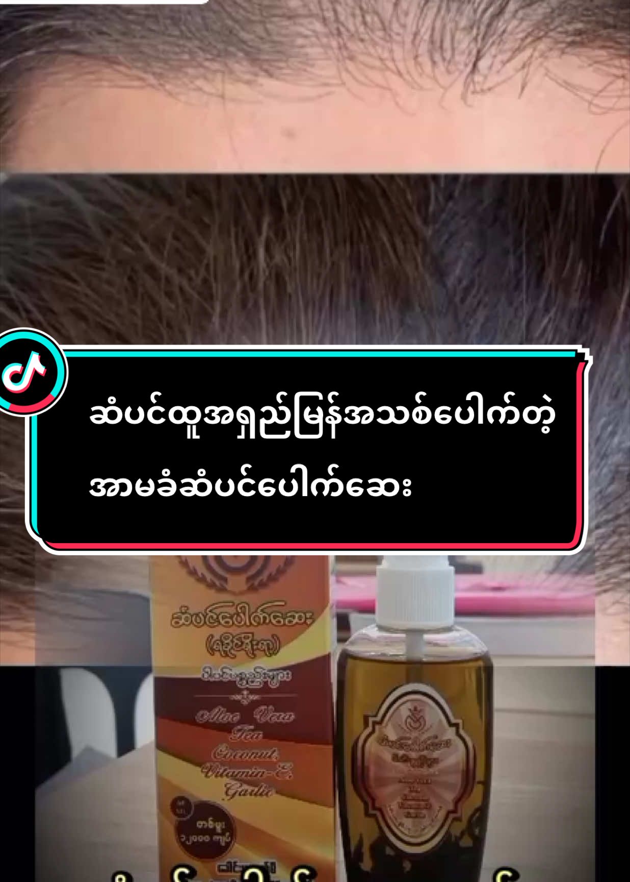 Replying to @chomar222 #09794145629 #ရခိုင်ရိုးရာခေါင်းလျှော်ရည် #SMBrand #အာမခံဆံပင်ပေါက်ဆေး 