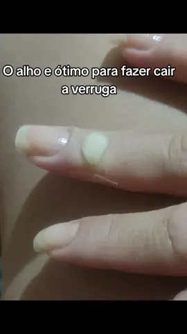 dica para cair a verruga  #verruga  #dica  #verrugas  #alho 