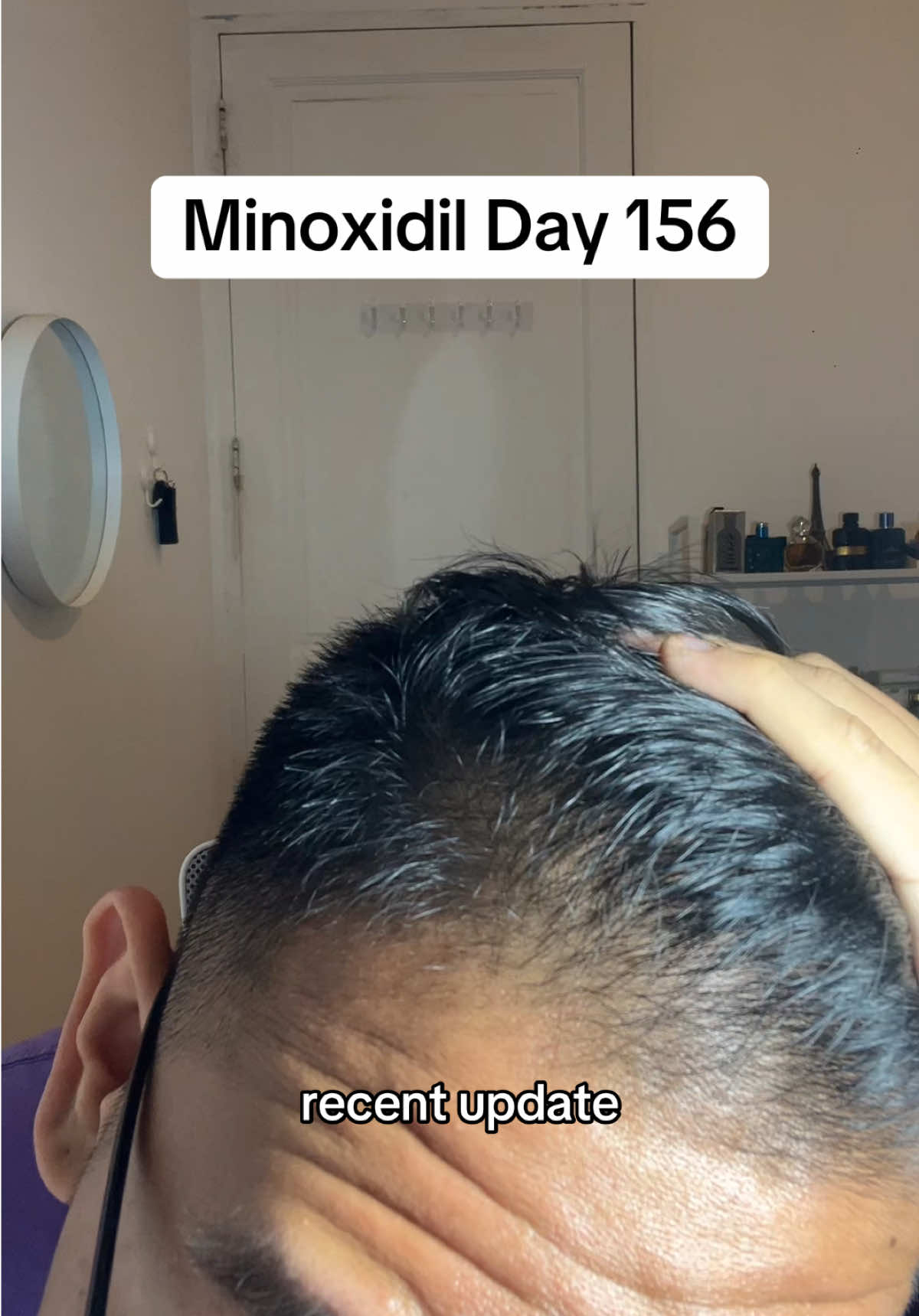 Penggunaan Minoxidil Hari ke-156 😀👍 #minoxidil #minoxidilresult #haircare #haircareroutine 