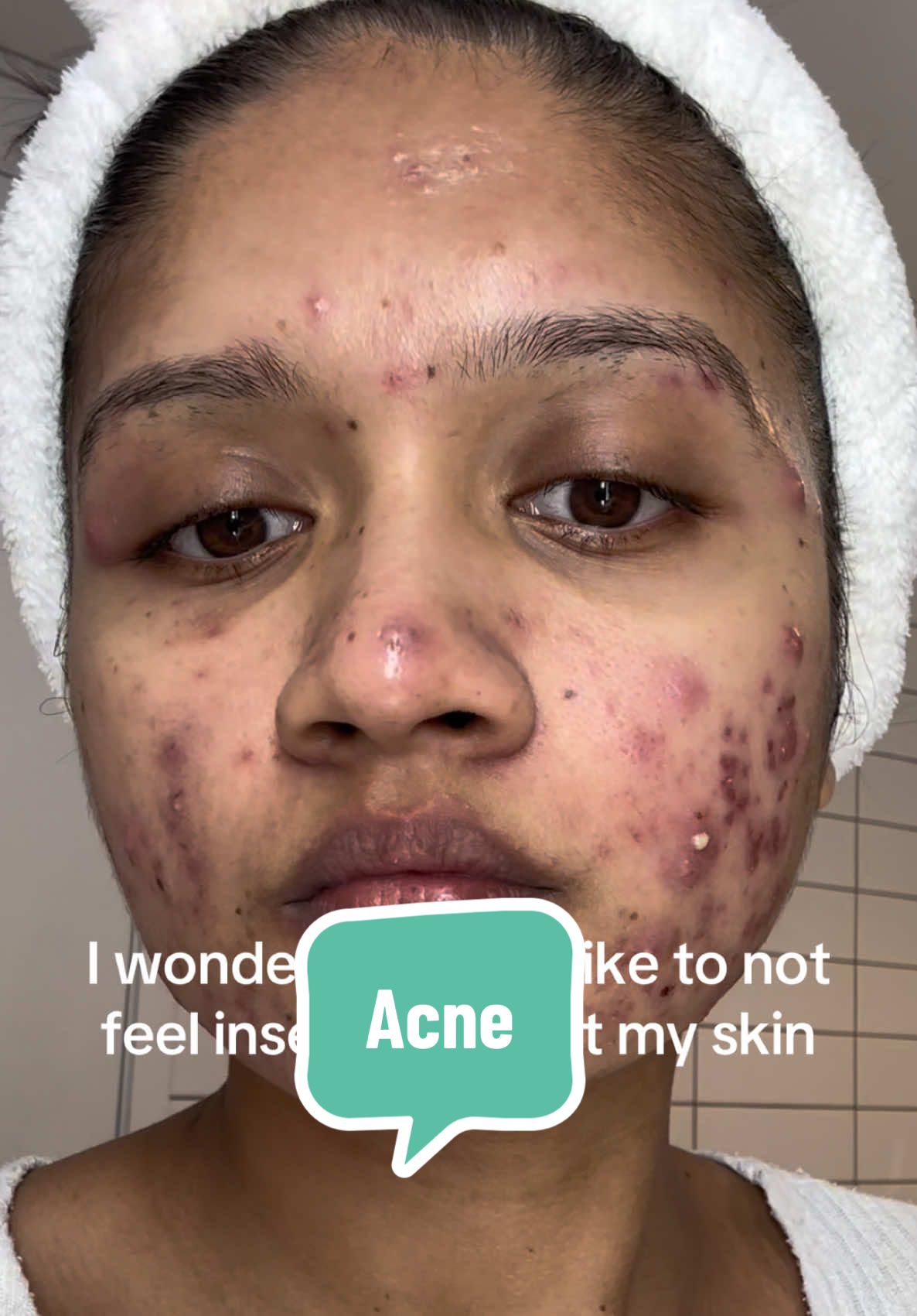 POV: You didn’t give up, and neither did your skin✌️✌️ Your skin is beautiful at every stage of your journey❤️🙏 #acneskin #acneskincare #acneproneskin #acnetreatment #acnefighter #acneglowup #acnetransform #acneresults #acnebeforeandafter #ancefree #acnefreeskin #acnepositive #acnecommunity #acneposivity #acnenormalization #cysticacne #acnejourney #acneprone 