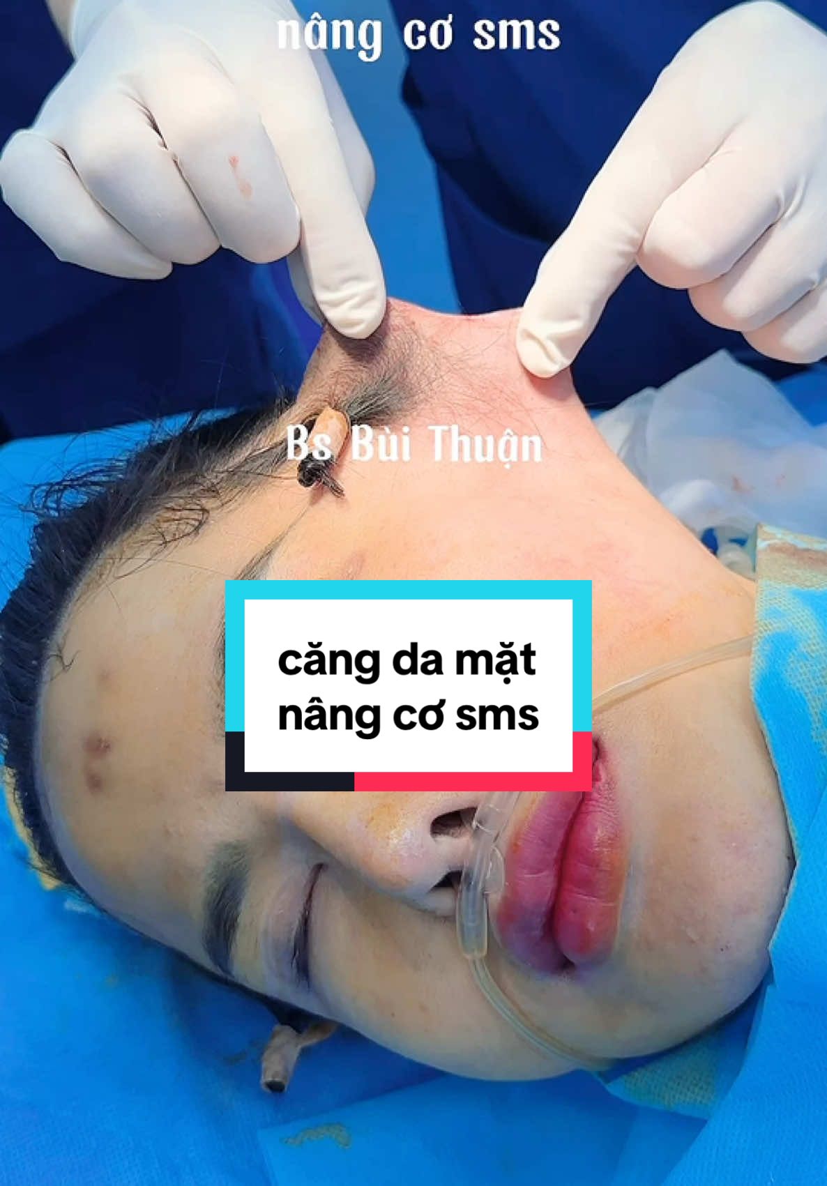 căng da mặt nâng cơ sms 15 tr#bsbuithuan #pttm #cangda #cangdamat #cangdatran #cangdacangco #cangdamini #cangdathaiduong #cangdamattoanphan #trehoa #trehoada #trehoakhuonmat #nangcomat #xoanhan #xoanhantran #canchinhkhuonmat #xuhuong #viral #video #trend #facelift #tphcm #phunu #lamdep #