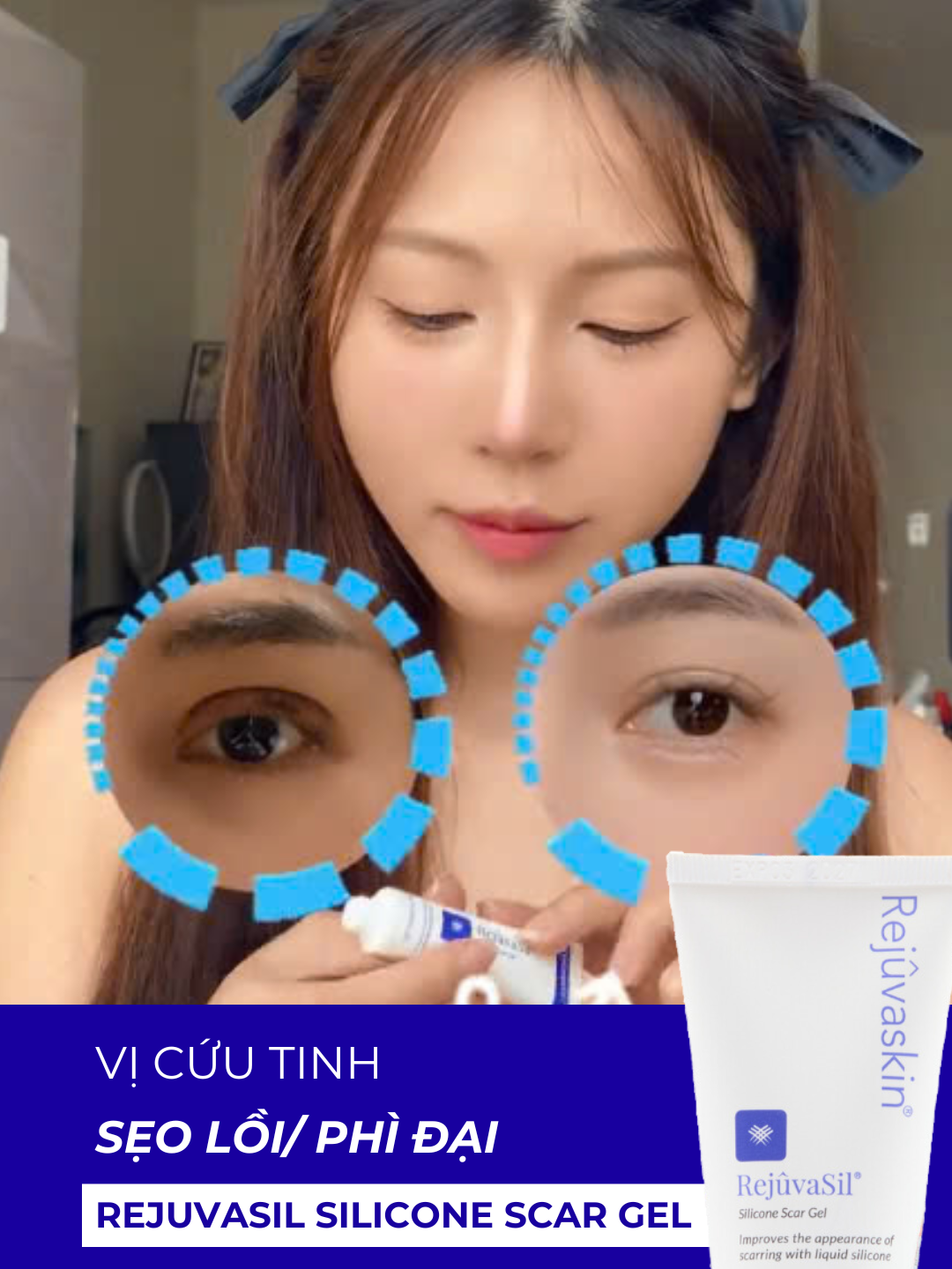 Cắt mí xong dùng sản phẩm nào cho phù hợp? #rejuvaskinvietnam #rejuvaskin #duongam #rejuvasil #scaresthetique #scarfx #miengdanseo #kemtriseo #seoloi #saotham