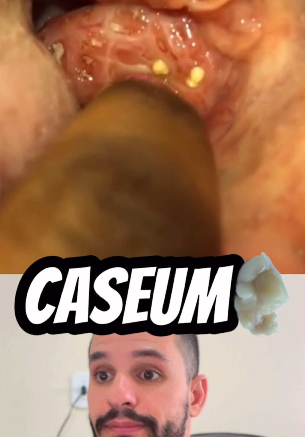 O caseum, também chamado de cáseos ou cáseos amigdalianos, são pequenas bolinhas brancas que podem surgir na garganta e que acontecem devido ao acúmulo de restos de alimentos, saliva e células da boca, sendo responsáveis pelo mau hálito, garganta inflamada e, em alguns casos, dificuldade para engolir. Na maioria dos casos, o cáseo não precisa de tratamento, isso porque consegue desprender-se naturalmente das amígdalas, podendo ser engolidas pela pessoa sem que sejam notadas. No entanto, o tratamento pode ser recomendado quando há dor, desconforto ou mau hálito devido ao cáseo. Os sinais de melhora do caseum podem demorar até 3 dias para surgir e incluem diminuição do número de bolinhas na garganta e redução do mau hálito. #caseum #boca #dente