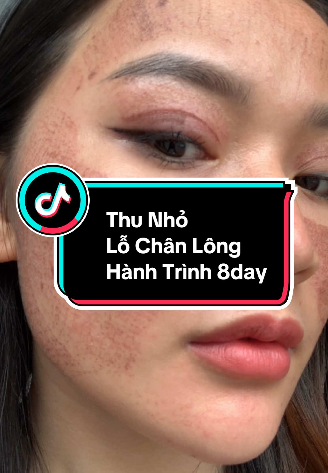 🌎 Hành Trình Chăm da . Thu lỗ chân lông, Trị sẹo , Trẻ hoá #fullfacecoldplasma #thunholochanlong #triseodaynhon #triseoro #coldplasma #simplebeauty #daotaospachuyennghiep 