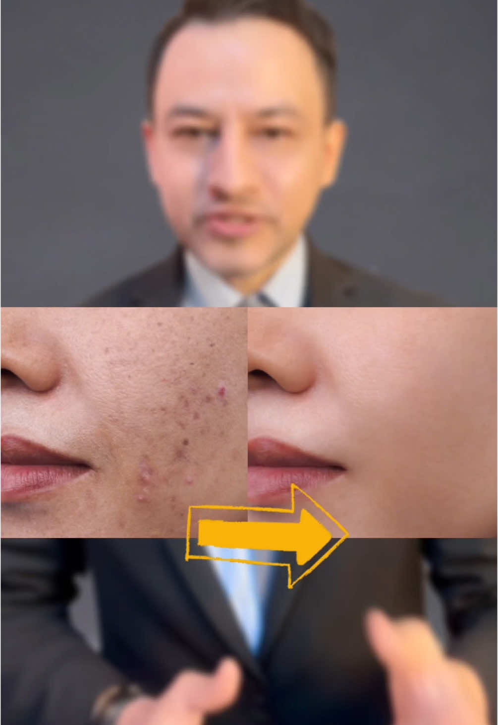 PIH or post inflammatory hyperpigmentation is a stubborn skin pigmentation due to the inflammation during active acne. These simple steps can help you get rid of this acne pigmentation. (Remember to hit that follow button for similar videos.) Step 1 : Use a salicylic acid or glycolic acid based cleanser or face wash.  - For Salicylic acid, choose the one with 2% salicylic acid (Start with 1% if you are sensitive or become dry and wash every alternate day if this happens.) - For Glycolic acid, you can use a cleanser or a toner above 5%. Step 2: Use a niacinamide serum at night after washing face. - Start with a 5% serum first if you think you have a sensitive skin. Otherwise, 10% niacin amide with zinc is tolerable for most skin type. - Niacinamide serum can be used in oily, dry, combination or normal skin type safely. - It is also safe during pregnancy. Step 3: At Doctor’s clinic, following procedures can be done. A. Chemical Peeling: This helps exfoliate the affected skin safer and faster giving immediate visible changes.  At Reva skin and hair clinic, one session of this procedure costs Npr 2500 and in average, 4 sessions are required. B. Microneedling: This is one of the safest and the most effective choice when it comes to treating pigmentation and acne scars. At Reva skin and hair clinic, each session of micro needling costs Npr 4000 and in average, 4 sessions are done. #skincare #pigmentation #bestserum #vitaminc #retinol