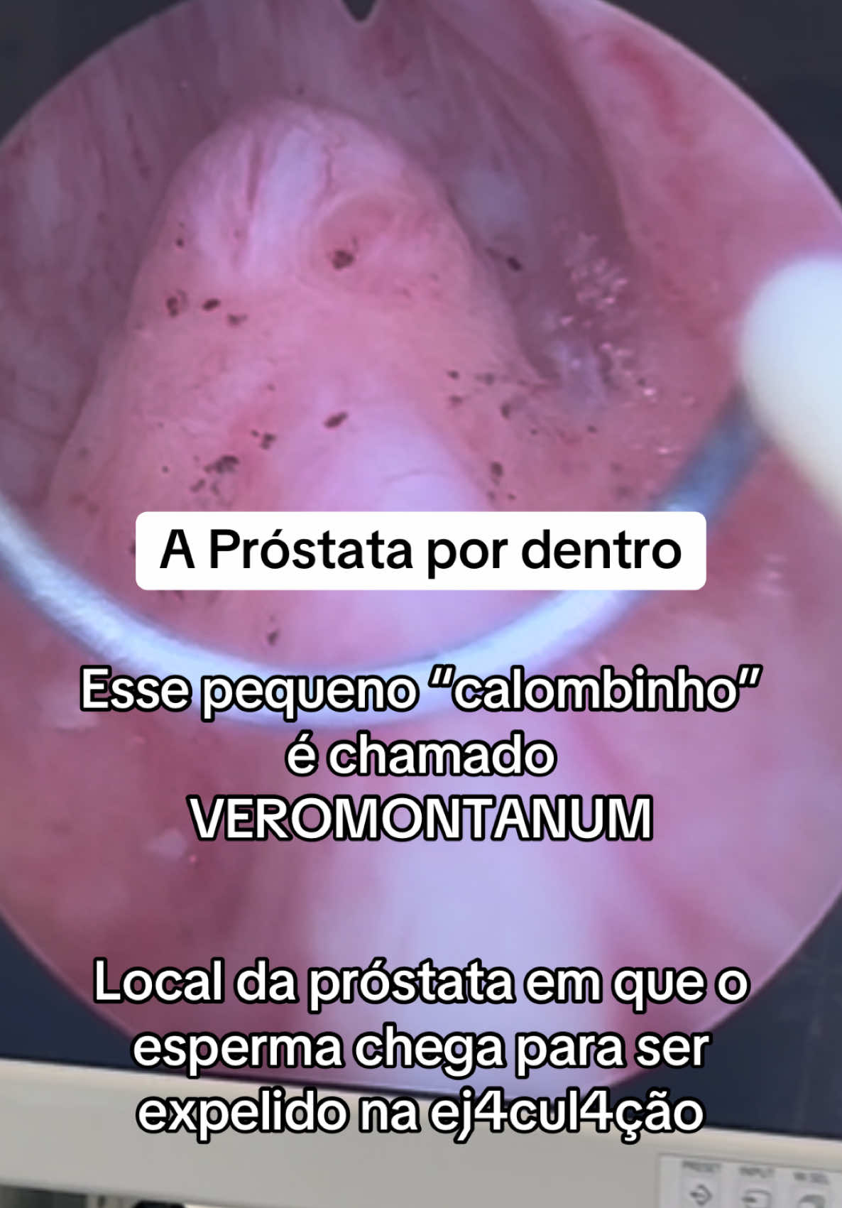 Veromontanum, uma área importante da próstata. Um dos marcos que utilizamos durante a cirurgia endoscópica, Rezum, Greenlight, Holep e RTU #prostataaumentada #hiperplasiaprostatica #prostata #veromontanum 