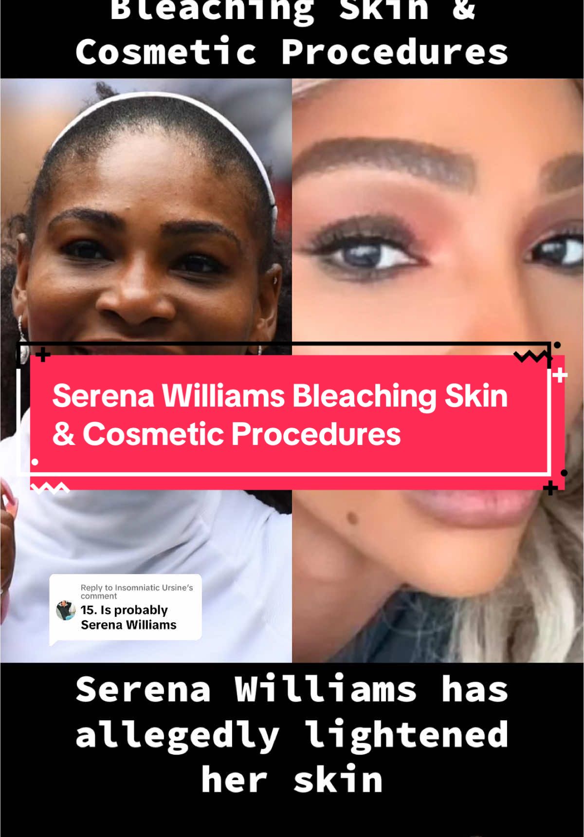 Replying to @Insomniatic Ursine Serena Williams Bleaching Skin & Cosmetic Procedures Source: @entylawyer crazydaysandnights.net, agcwebpages.com #serenawilliams #serenawilliamsedit #serenawilliamsskin #serenawilliamspleaseexplain #serenawilliamsmakeup #serenawilliamsfans #blinditem #blinditems #blinditemreveal #blinditemsrevealed #celebrityblinditems #celebritygossip #celebritynews #foryou #tiktokviral #viral #trending #fyp #greenscreen 