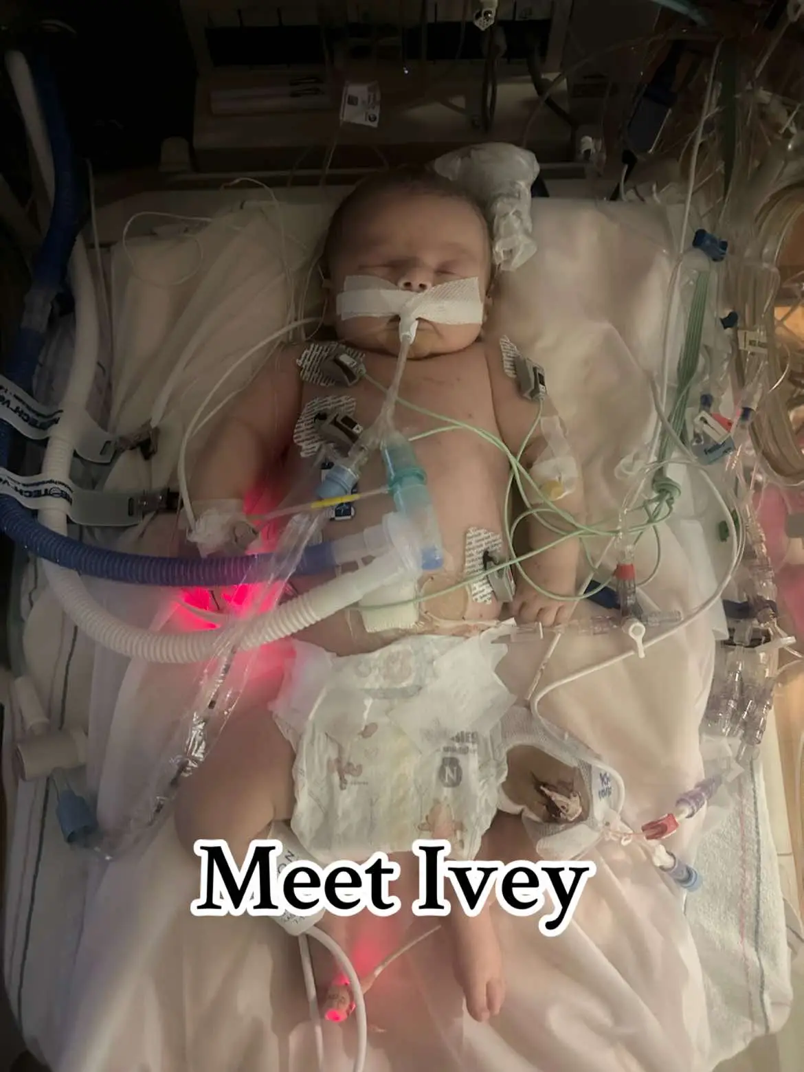 Everyone meet Ivey. We have been in the hospital since she was born on Ocotber 10th. She is waiting for a new heart. ❤️ #chd #chdawarness #heartwarrior #heartdefect #vad #ventricularassistdevice 